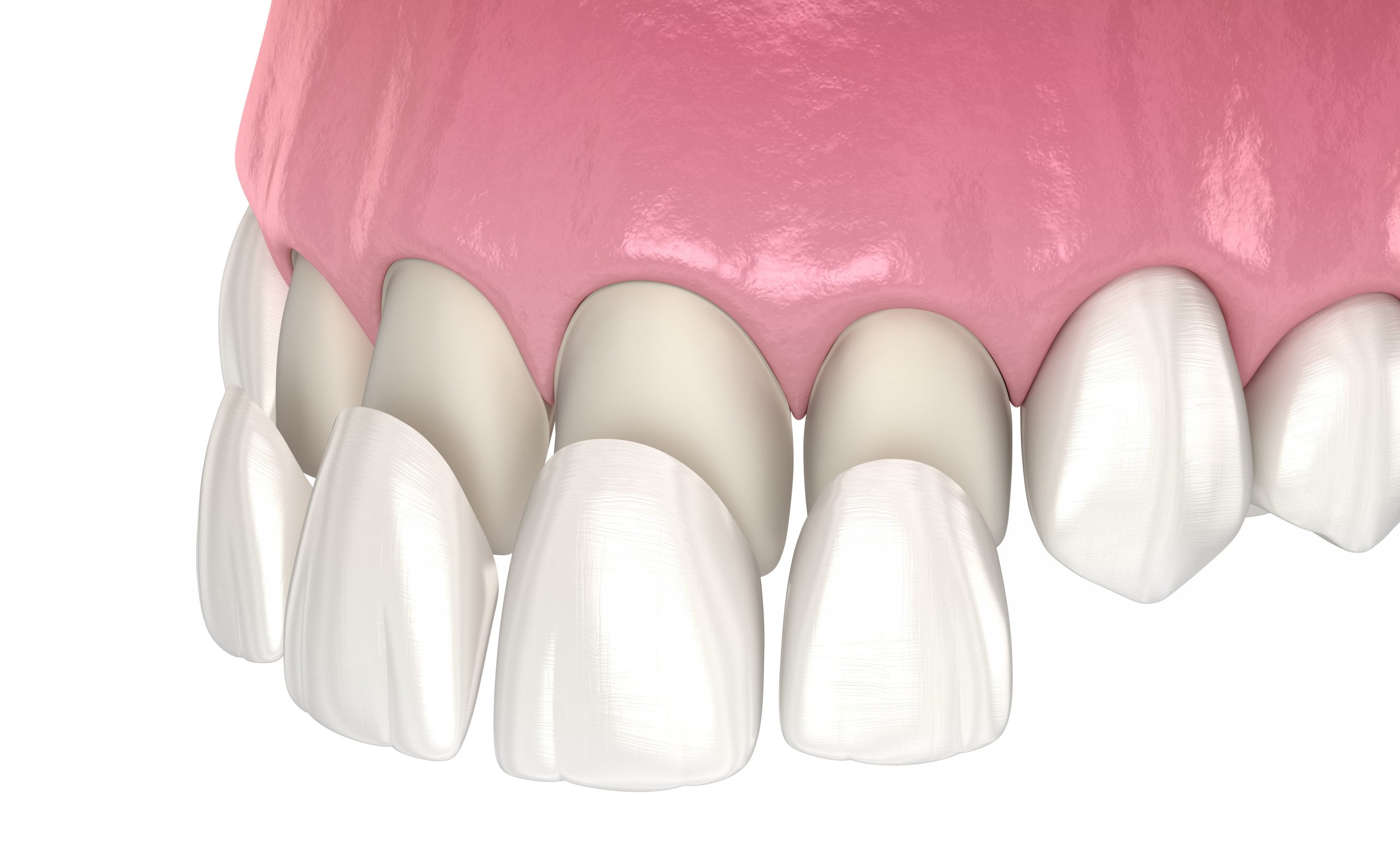 Dental Veneers in Tacoma WA