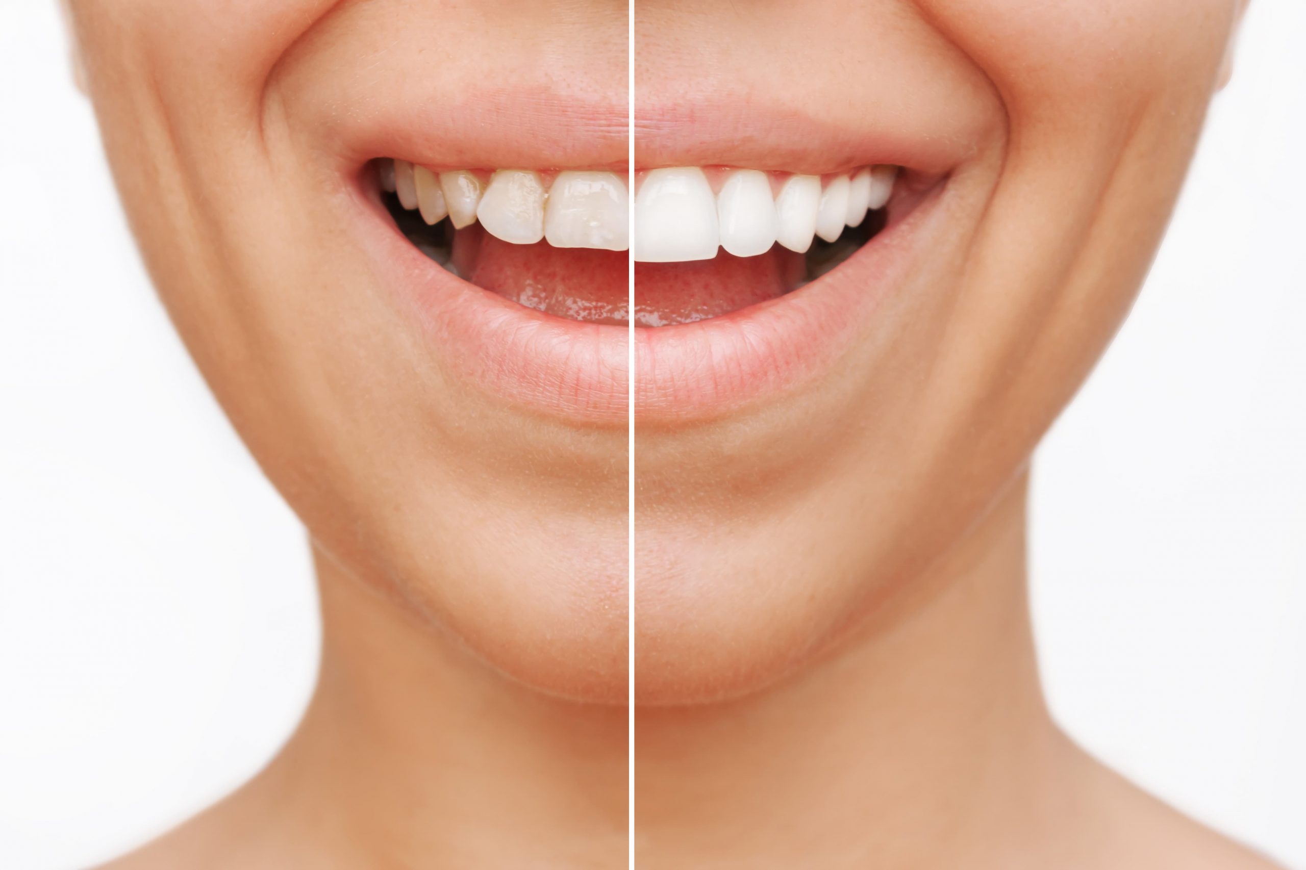 Dental Veneers in Tacoma WA