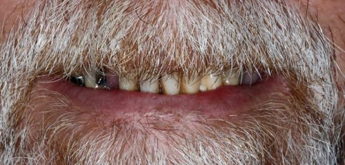 Dental Implants Before