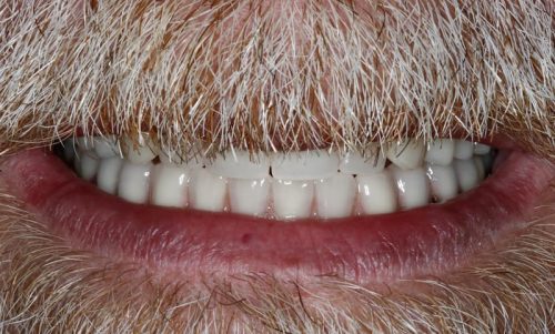 Dental Implants After