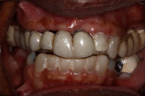 Dental Implants Before