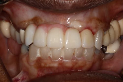 Dental Implants After